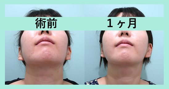 頬コケ脂肪注入_術後1ヶ月ダウンタイム