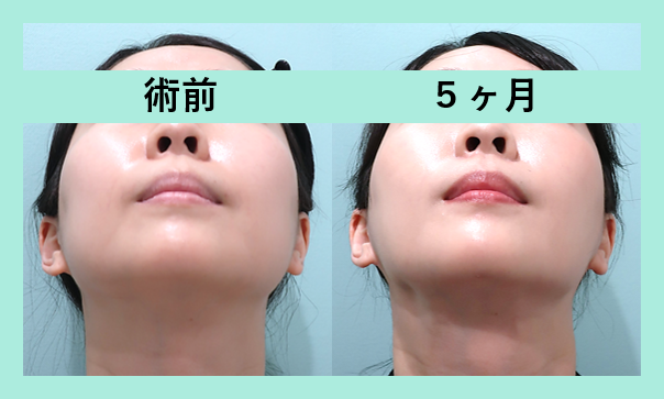 頬こけ脂肪注入 東京 銀座の美容外科クリニックwom Clinic Ginza 頬こけ脂肪注入 東京 銀座の美容外科クリニックwom Clinic Ginza