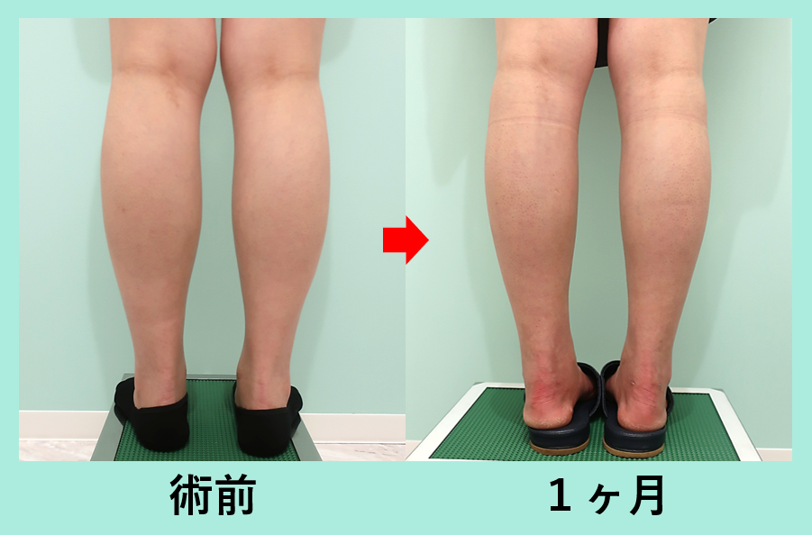 ふくらはぎ 足首をしっかり細く ナチュラルな感じを損なわないように丁寧な吸引を心がけています 東京 銀座の美容外科クリニック Wom Clinic Ginza