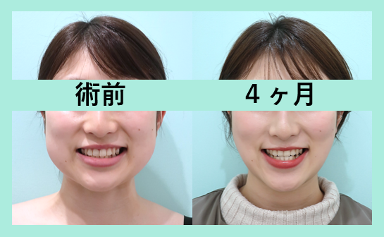 太ってもリバウンドなし 永久的な効果の小顔治療 東京 銀座の美容外科クリニック Wom Clinic Ginza