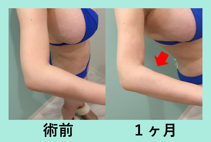 脹脛＋前腕脂肪吸引_ベイザー_術後1ヶ月ダウンタイム
