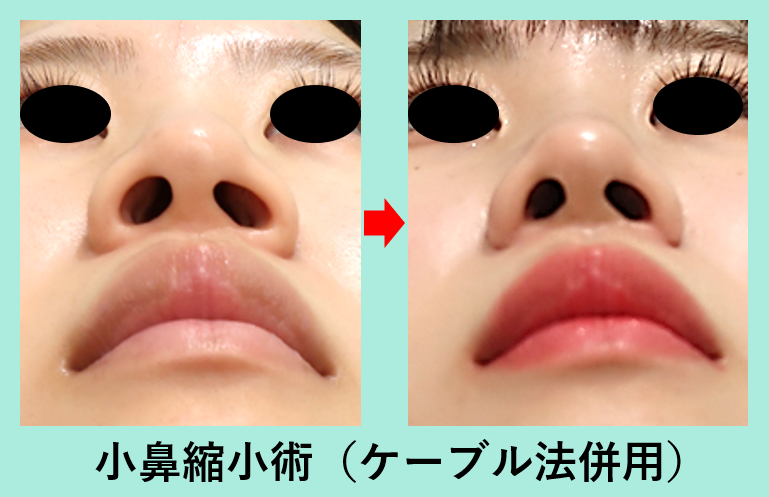 小鼻縮小＋ケーブル法_ビフォアフター