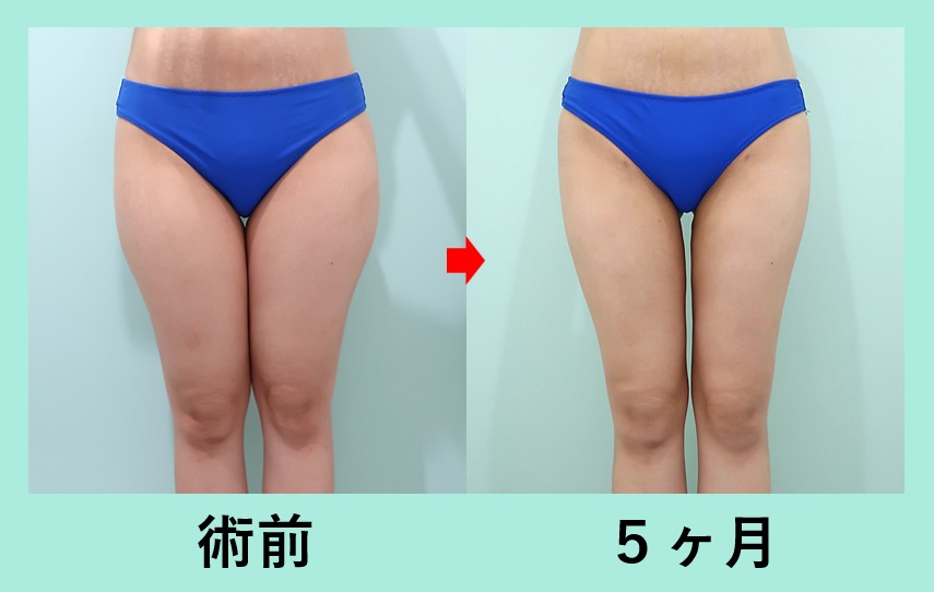 太もも全周＋下臀部の脂肪吸引_術後5ヶ月、ベイザー、ダウンタイム