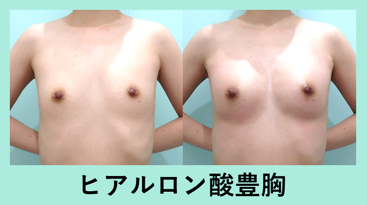 ヒアルロン酸豊胸_ビフォーアフター