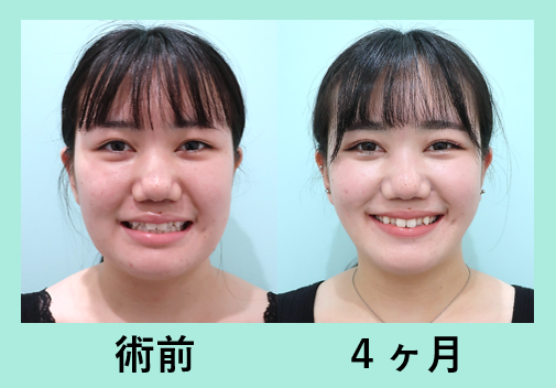 脂肪吸引だけだと弛むって聞くけど本当はどうなの ぶっちゃけ ２０代の方は糸リフトなしでも大丈夫です 東京 銀座の美容外科クリニック Wom Clinic Ginza