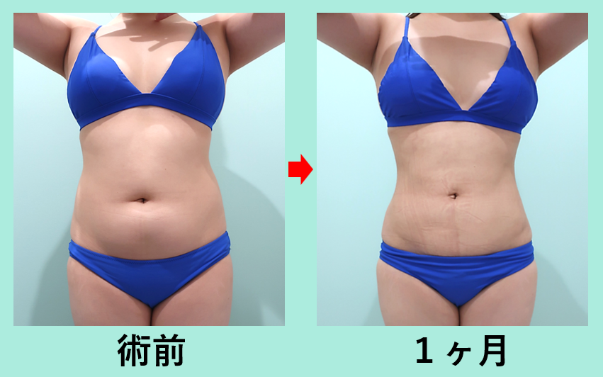 お腹+胸下+背中+腰の脂肪吸引_術後1ヶ月、ダウンタイム