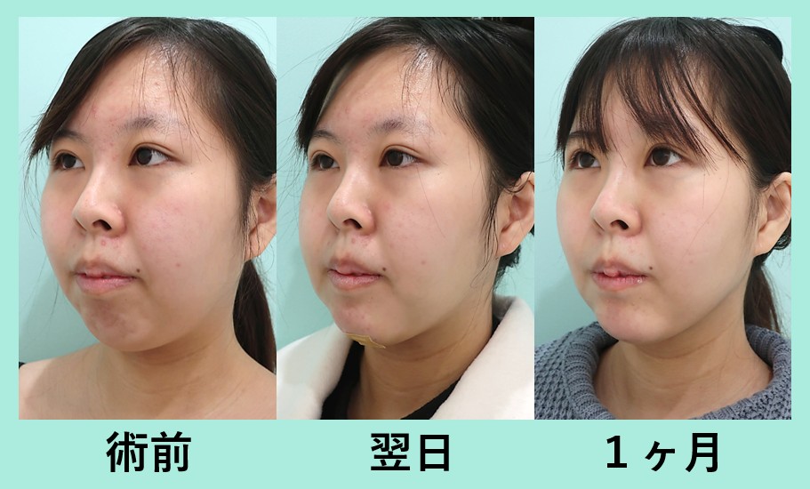 顎プロテーゼ＋頬と顎下の脂肪吸引_術後1ヶ月、ダウンタイム