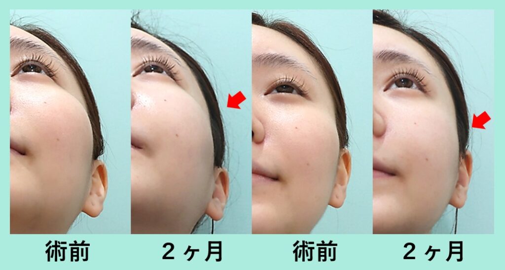 『『 頬骨骨切り 』+『 顔の脂肪吸引 』 同時手術で、小顔効果を最大に！』の画像