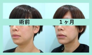 『横顔を変える『 顎プロテーゼ術 』ダウンタイムは意外と少ない！？』の画像
