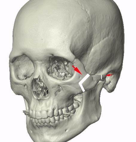 頬骨切りシェーマ