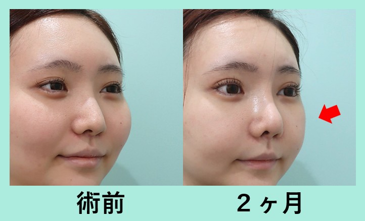 『『 頬骨骨切り 』+『 顔の脂肪吸引 』 同時手術で、小顔効果を最大に！』の画像