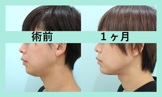 顎プロテーゼ＋頬と顎下の脂肪吸引_術後1ヶ月、ダウンタイム