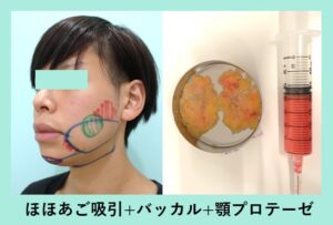 『横顔を変える『 顎プロテーゼ術 』ダウンタイムは意外と少ない！？』の画像