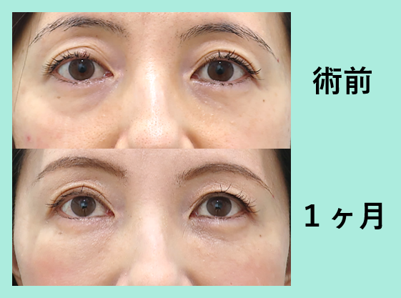 目の下脂肪注入_術後1ヶ月、ダウンタイム