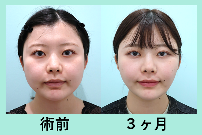 頬骨骨切り 顔の脂肪吸引 同時手術で 小顔効果を最大に 東京 銀座の美容外科クリニックwom Clinic Ginza 頬骨骨切り 顔の脂肪吸引 同時手術で 小顔効果を最大に 東京 銀座の美容外科クリニックwom Clinic Ginza