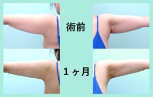 『二の腕から１３００ｃｃの大量吸引！ 気になる術後のタルミを最小限に抑えるハイレベル脂肪吸引』の画像