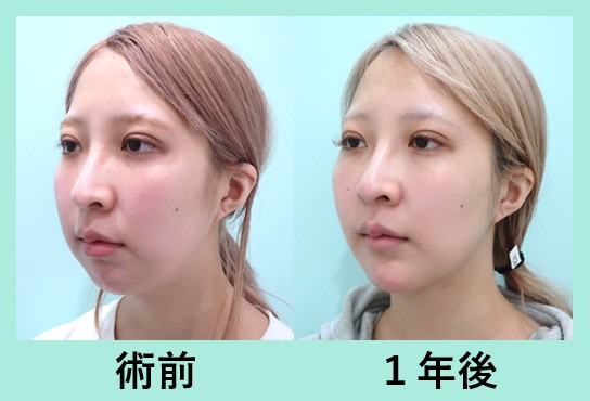 顎プロテーゼ＋頬と顎の脂肪吸引、術後1年