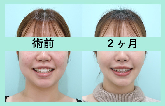 小顔治療の症例参考画像