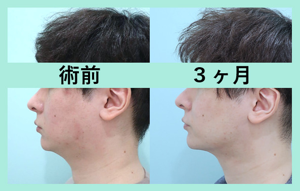 男性の施術が増えています バッカルファット術 東京 銀座の美容外科クリニック Wom Clinic Ginza 男性の施術が増えています バッカルファット術 東京 銀座の美容外科クリニック Wom Clinic Ginza