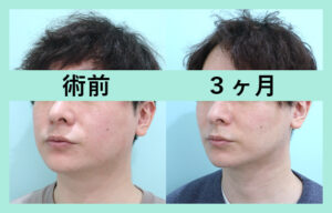 『男性の小顔治療が人気です！ 耳下腺ボトックス併用で効果抜群に！』の画像