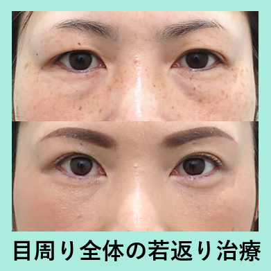 目の下脂肪取り＋眉下切開_ビフォーアフター