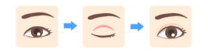 double-eyelid-surgery９