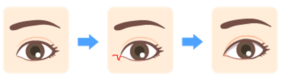 double-eyelid-surgery11