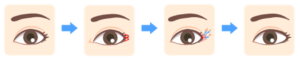 double-eyelid-surgery10