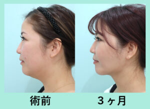 『もう丸顔とは呼ばせない！ 人生を変える WOM の最強小顔脂肪吸引！』の画像