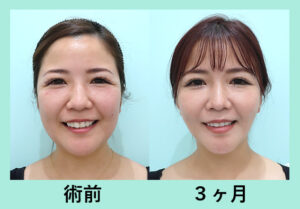 『もう丸顔とは呼ばせない！ 人生を変える WOM の最強小顔脂肪吸引！』の画像