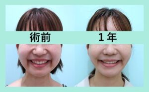 『１年経過してもリフトアップ効果をしっかりキープ！ＷＯＭの小顔治療はやっぱりすごい！』の画像