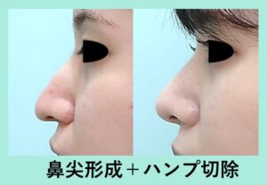 『耳軟骨移植なしの鼻尖形成術で、歪んだ鼻も細くかつ自然な鼻先にリメイク！』の画像