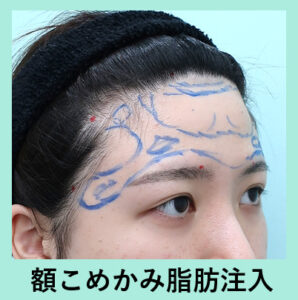 可愛いベビーフェイスに変身 額こめかみへの脂肪注入 東京 銀座の美容外科クリニック Wom Clinic Ginza 可愛いベビーフェイスに変身 額こめかみへの脂肪注入 東京 銀座の美容外科クリニック Wom Clinic Ginza