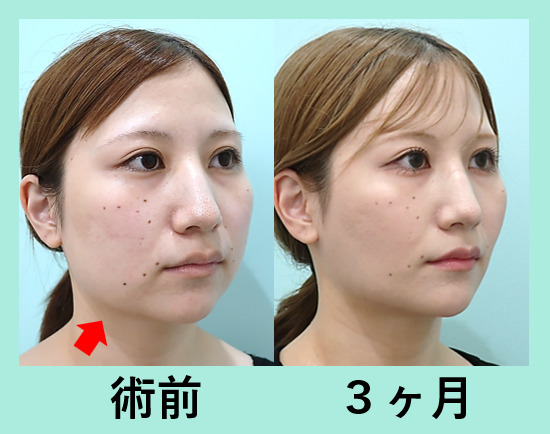 小顔治療の症例参考画像
