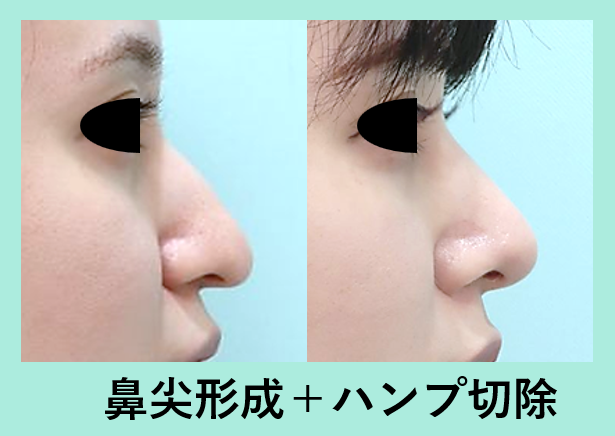 鼻形成の症例参考画像
