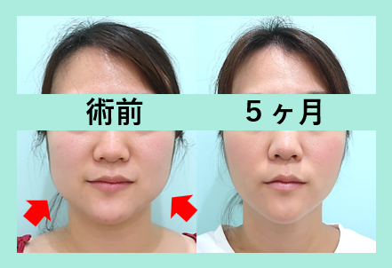 頬顎下脂肪吸引+糸リフト_術後5ヶ月