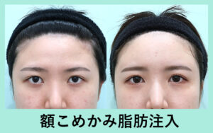 可愛いベビーフェイスに変身 額こめかみへの脂肪注入 東京 銀座の美容外科クリニック Wom Clinic Ginza 可愛いベビーフェイスに変身 額こめかみへの脂肪注入 東京 銀座の美容外科クリニック Wom Clinic Ginza