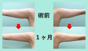 『二の腕から８００ｃｃの大量吸引！術後のタルミを最小限に抑えるベイザー脂肪吸引手術』の画像