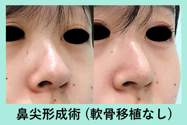 鼻形成の症例参考画像