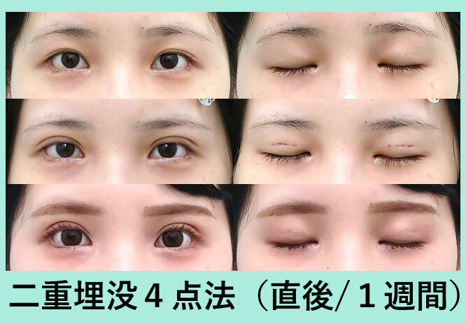二重 垂れ目形成 東京 銀座の美容外科クリニック Wom Clinic Ginza 二重 垂れ目形成 東京 銀座の美容外科クリニック Wom Clinic Ginza