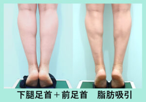 『足首・ふくらはぎ脂肪吸引のパイオニア！独自技術でしっかりと細い脚へ！』の画像