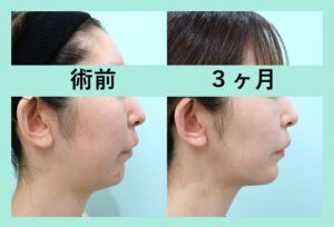 『両顎手術！？メーラー脂肪吸引 + 顎プロテーゼ の組み合わせ治療で『 顔の立体感 』を変える』の画像