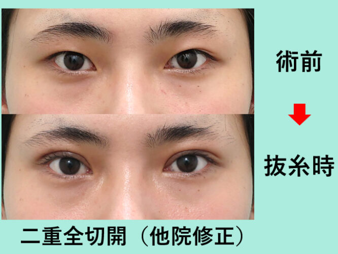 二重 垂れ目形成 東京 銀座の美容外科クリニック Wom Clinic Ginza 二重 垂れ目形成 東京 銀座の美容外科クリニック Wom Clinic Ginza