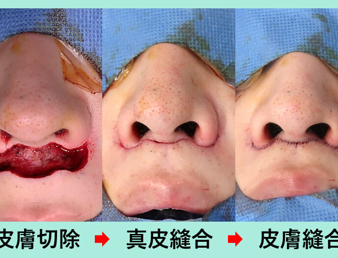 鼻整形の症例参考画像