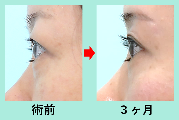 二重 垂れ目形成 東京 銀座の美容外科クリニック Wom Clinic Ginza 二重 垂れ目形成 東京 銀座の美容外科クリニック Wom Clinic Ginza