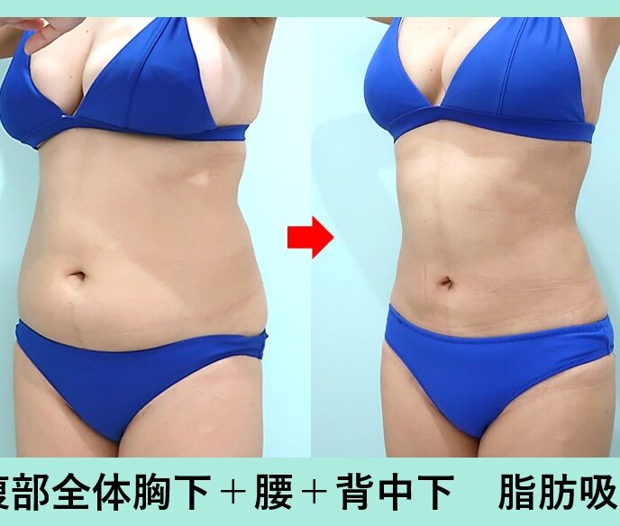 脂肪吸引・豊胸の症例参考画像