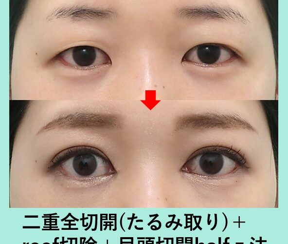 二重全切開＋たるみ取り＋roof切除_術後１ヶ月