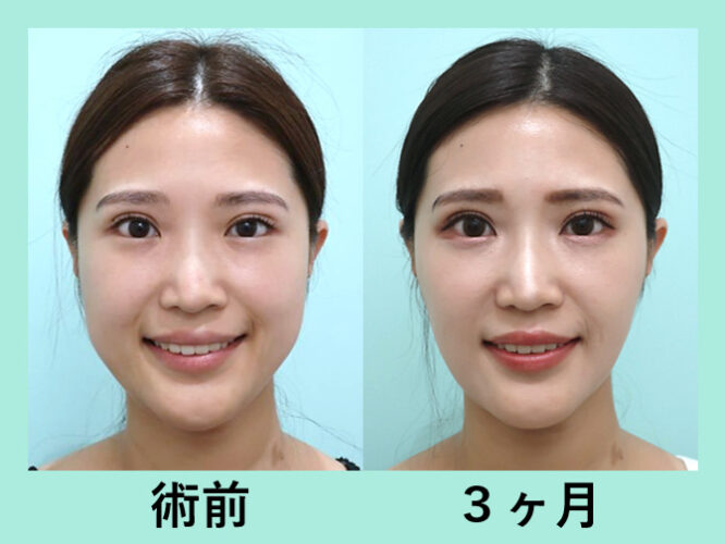 頬顎下脂肪吸引＋糸リフト＋エラボトックス_術後３ヶ月
