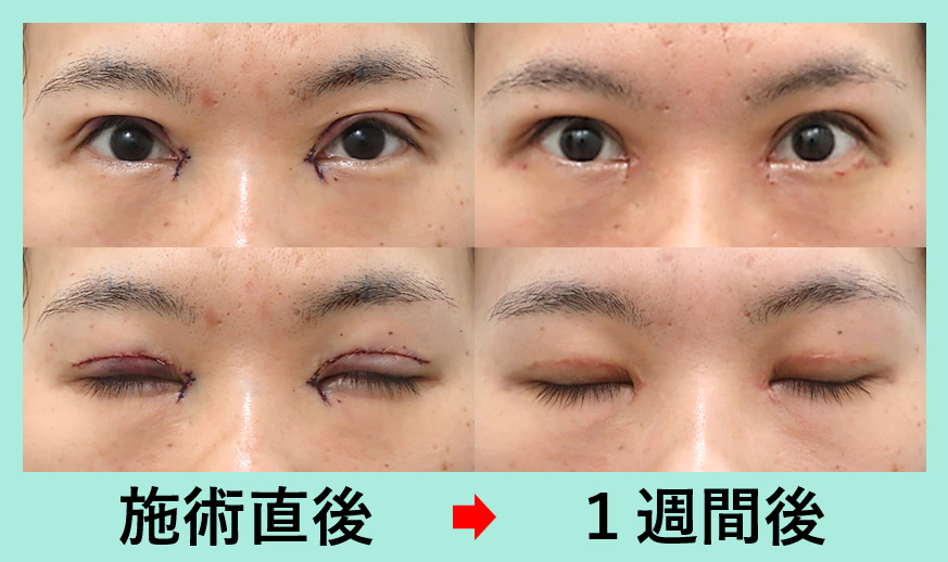 『皮膚のたるみも眼瞼下垂も強い方の二重切開施術をご紹介』の画像