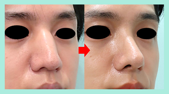 鼻整形の症例参考画像